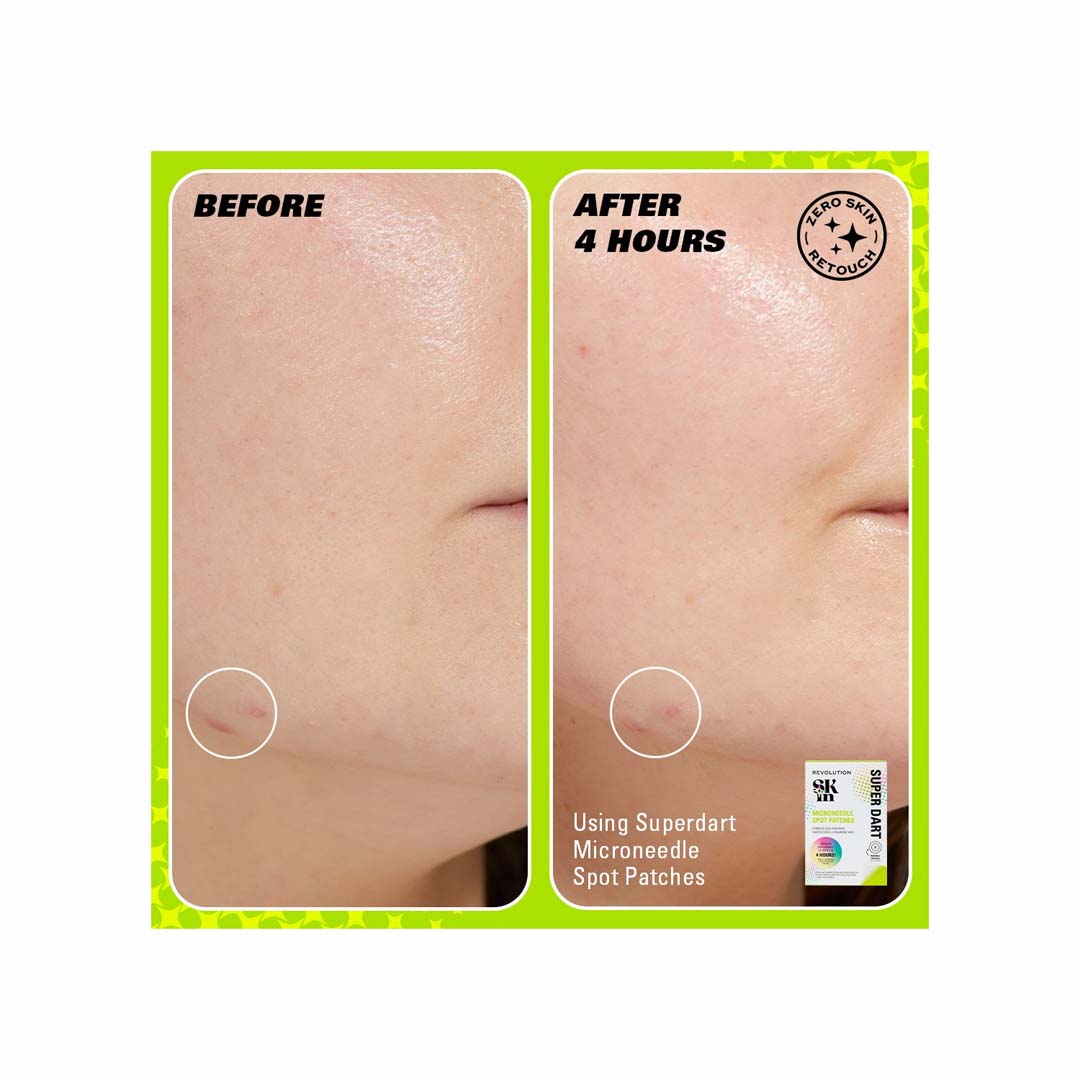 24074 Revolution Skin Super Dart Microneedle Salicylic Acid Hydrocolloid Spot Patches (3)